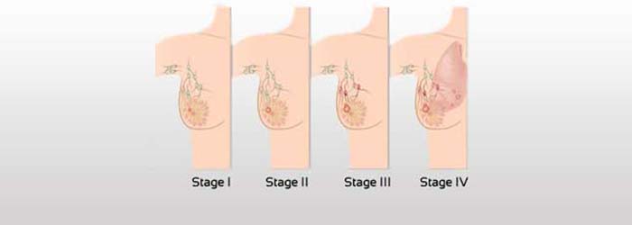breast-cancer