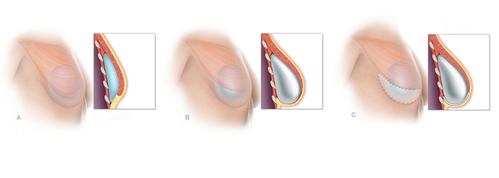 breast-construction-surgery