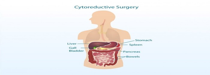 cytoreductivesurgery