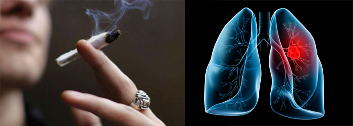 lung