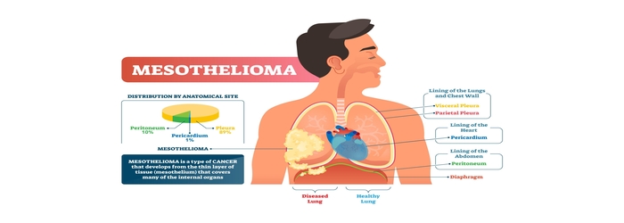 mesothelioma