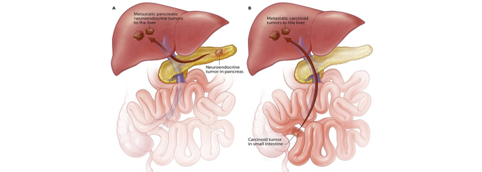 neuroendocrine