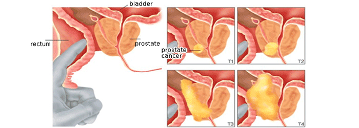 prostate