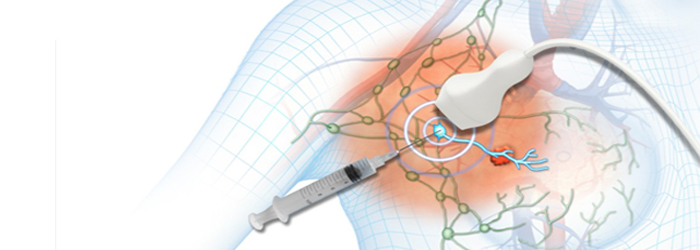sentinel-lymph-node-biopsy