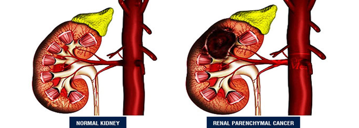 urology-kidney
