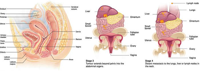 uterus-cancer
